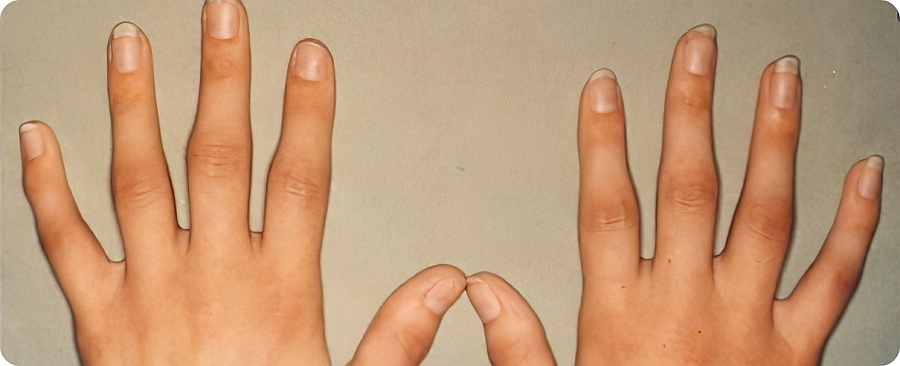 Reumatsko oboljenje prstiju šake, rana faza