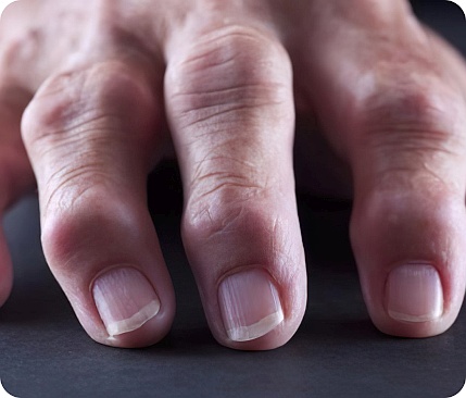 Zapaljensko reumatsko oboljenje zglobova na prstima