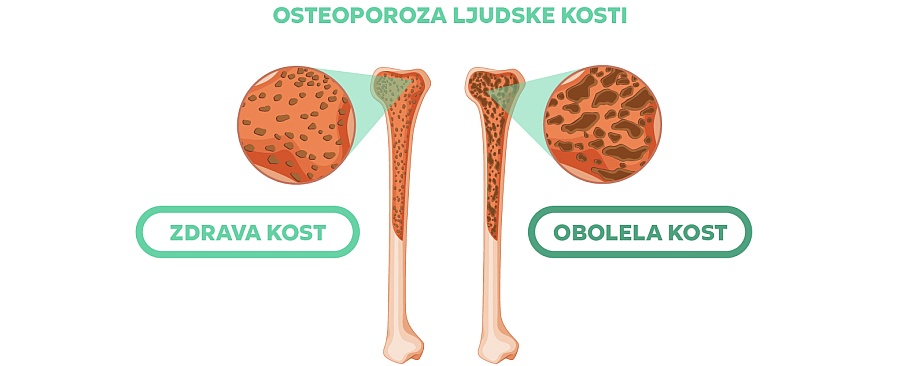 Osteoporoza, zdrava kost i obolela kost
