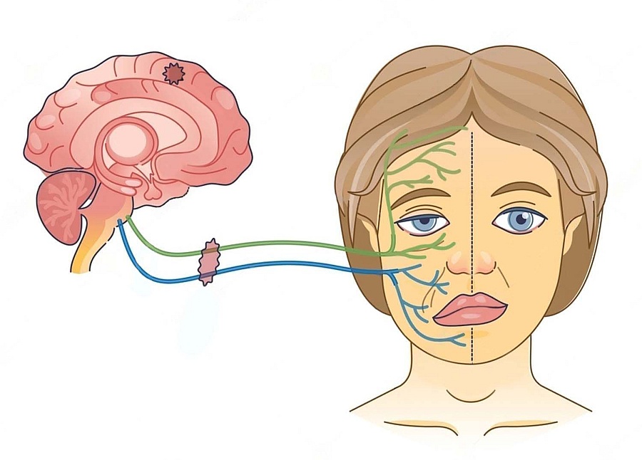 paraliza nerva lica, grafički prikaz
